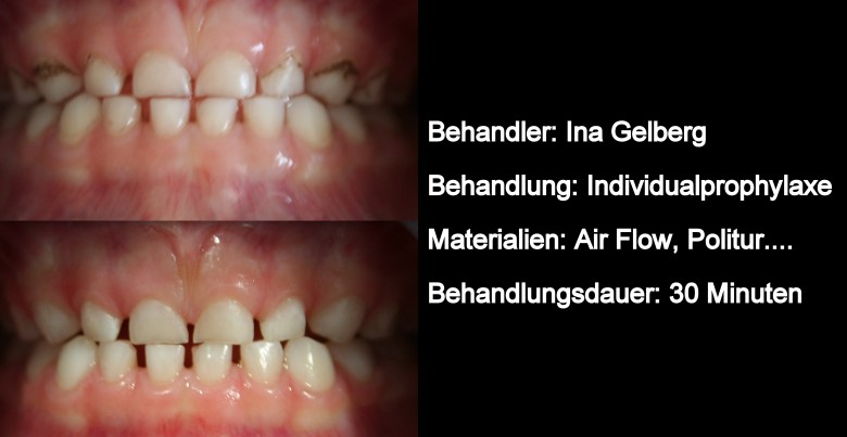 Individualprophylaxe beim Zahnarzt